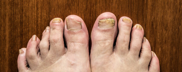 Fungal Nail Infections