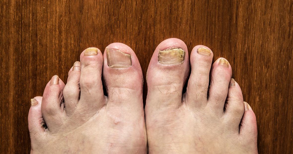 Fungal Nail Infections